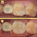 진플란티아치과의원 | 남부터미널치과 간단한 치료라도 신중해야 하는 이유