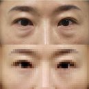 옳은손성형외과 네이버블로그