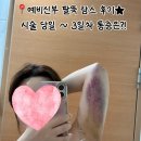 팔뚝 무한람스 후기 | 당일~3일차 붓기, 통증, 멍, 부작용, 효과, 비용