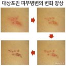 면역억제제의 피부과적 부작용 이미지