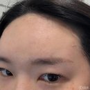 천호피부과 자연스러운 이마 필러 잘하는곳 큐티필 시그니처 딥 후기