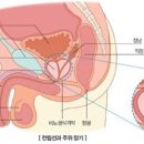 전립선 이야기 이미지