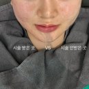 뚝섬유원지 피부과 본태의원 이중턱 튠페이스 튠라이너 시술받은 후기