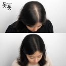 두피를 디자인하는 여자 | 여자 두피문신, 티 안 나게 머리숱을 채우는 방법