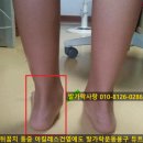 아킬레스건염이 생기는 원인과 해결법-발가락운동용구 듀트 이미지