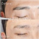 신 짱구 | 인천부평 눈썬문신제거전문 🤍브로우리아 추천 !! 진한 짱구눈썹 탈출 후기