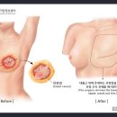 유방재건술[상세불명의 유방의 악성신생물(C5099)로 좌측 유방절제술 및 복원술*시행] 실손의료비 보상여부 이미지
