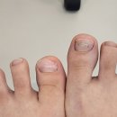 레푸스 정자점 | 레푸스 분당정자점에서 내성발톱 관리받은 후기