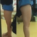 [엔슬림 허벅지+뒷구리 미니] 빈이의 허벅지 지방흡입 3년 후 모습입니다 ^^ 1800cc흡입! 이미지