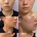 뷰티;쁨 | 신논현 쁨의원 통증없이 바로 효과보는 울트라인 리프팅 300샷 후기