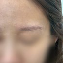 수원-1610 | 수원 붉은눈썹 잔흔제거 뉴아뷰티 후기