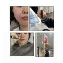 부산 줄기세포 피부주사 내돈내산 후기 I 미라셀 60KIT 풀페이스+리쥬란+수액 줄기세포 부작용 은?