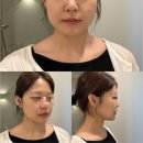 미소피부과의원 | 마산피부과 친절한미소의원 미글로우 후기, 직접 받아본 리프팅 솔직 리뷰