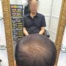 동탄가발 자연스러운 남자맞춤가발 김호증모가발by헤어리서치