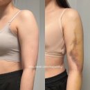 하단3-1 | 팔뚝 지방추출 팔뚝 무한람스 일주일 7일차 후기