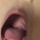 아이네오어린이집 | 아들의 구내염 고생기: 39도 고열에서 빠른 회복까지, 네오뮤코잘플러스의 힘