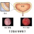 간질성 방광염(Interstitial Cystitis)증상 이미지