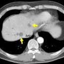 간낭종 증세 및 경과(간에 물혹, , 통증) 이미지