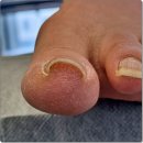 의정부 양주 덕계 내성발톱 고민의 해답 관리 후기 고려마디튼튼