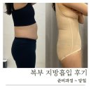정든약국 | 교대 복부지방흡입 당일 리얼 후기 (압박복 착용기간, 붓기, 멍)