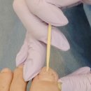 이천 문제성 발 전문 라파엘 내성발톱 관리 후기