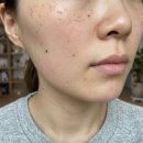 노벨약국 | 멜라닌크림 히드로퀴논 트라넥삼산 처방 크림 효능비교 후기