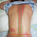CRPS(복합부위 통증증후군)치유법 이미지
