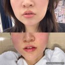 멍시티 | 해운대마린시티피부과 쿨페이즈 내돈내산 후기