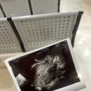 로미한의원 | [임신일기] 1. 갑자기 찾아온 복덩이❤️ 임밍아웃 | 임신 5주차 아기집+난황 확인 | 임신 극초기 증상