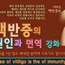 면역이 상실된 백반증의 주요 원인과 치료법 이미지