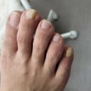 메디셀 | 남편의 오래된 발톱 고민, 발톱무좀약 메디셀온 고농축 발톱앰플 관리 후기!