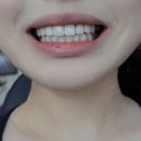 수정기공사 | 무삭제 라미네이트 가격 9년 고민하고 시술한 솔직한 후기 – 치과 선택 이유/부작용 해결하기