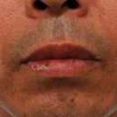 단계반점 이미지