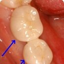 모델라인치과 임플란트 프로그램 이미지