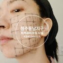 동남에너지 - 김해시 | (내돈내산) 청주 동남지구 피부과 - 울쎄라 + 써마지 + 입꼬리 보톡스 상담 & 1:1 맞춤 시술 후기