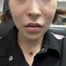 리즈벨의원 | 최고의 컴플렉스 였던 백반증 치료받으러 리즈벨의원으로~