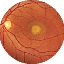 Best 난황형 황반부 이영양증 (Best vitelliform macular dystrophy) 이미지