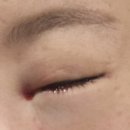 부동산리더 | 비루관폐쇄증 눈물흘림증 눈물샘막힘 실리콘삽관 튜브삽입술 내돈내산 수술후기 (feat.리더비치부동산)