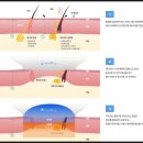 용인대 양천유도관(화곡점) | [겨드랑이 다한증, 액취증 치료] 국가대표도 선택한 미라드라이 프레쉬, 추가샷 맞춤 시술, 부천, 인천...