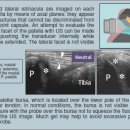 근골격계sono자료 Patella retinacula and patella medial articular facet 이미지