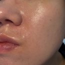 균일광고 | 대구 수성구 피부과 고우리 스킨부스터 내돈내산 후기 (광고X)