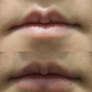 [창원진해입술필러] 입술 필러 용량 1cc면 충분할까? 과유불급 디자인 노하우