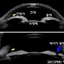 [김안과병원] 녹내장 간단명료하게 생각하기: ‘GIFT’ (1) – 녹내장의 종류 이미지