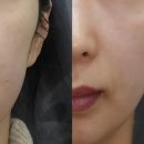 힐로