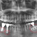 임플란트 치아의 선택 이미지