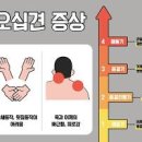 어깨통증 오십견 원인 예방 이미지