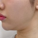유지글로벌 | 카인드글로벌의원, 을지로 온다리프팅 효과 이중턱 정리 내돈내산 리얼 후기!