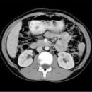 김밥옆구리 이미지