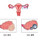 난소의 양성 종양 (Benign ovary tumor) 여성질환, 종양혈액질환이란? 이미지