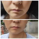 정부과천청사부속의원 | 과천 정부과천청사역 피부과 고주파리프팅 텐써마 가격, 후기, 통증, 추천이유